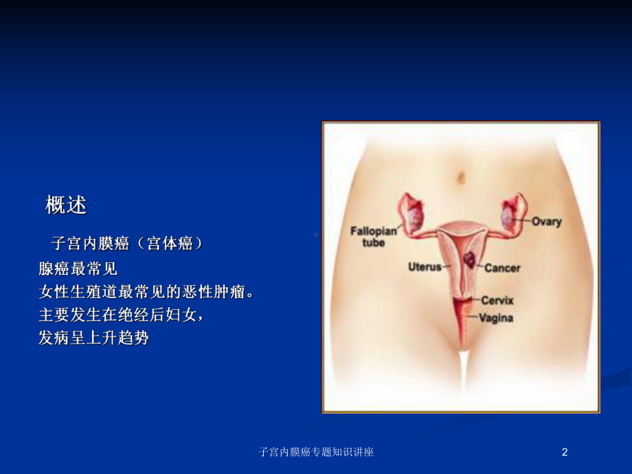 子宫内膜癌专题知识讲座培训课件.ppt_第2页