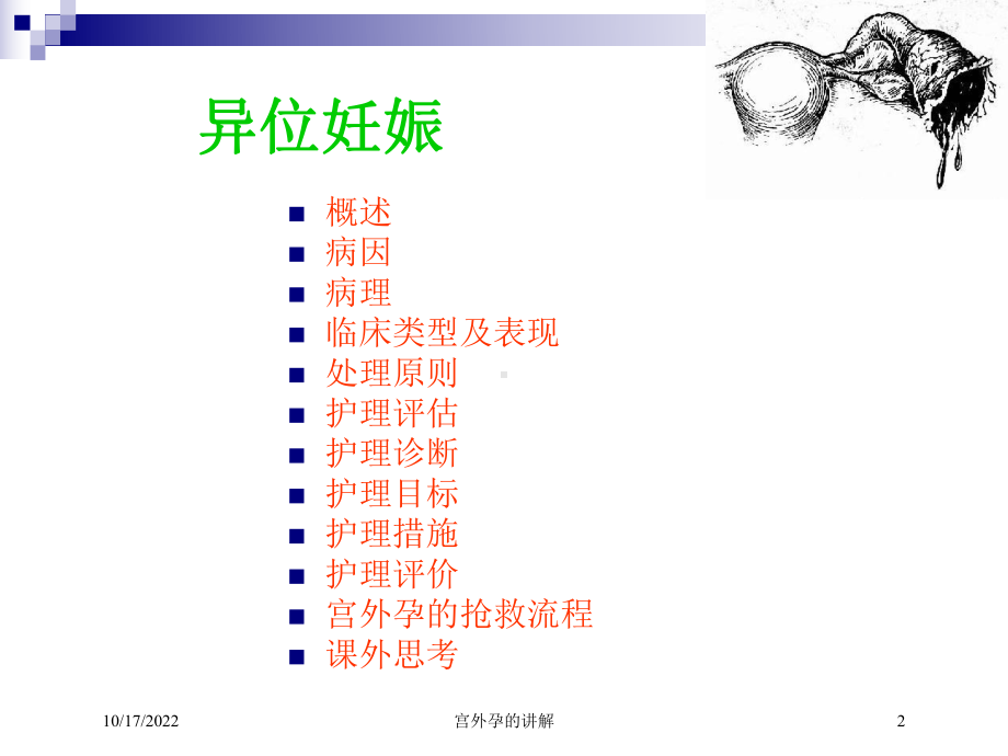 宫外孕的讲解课件.ppt_第2页