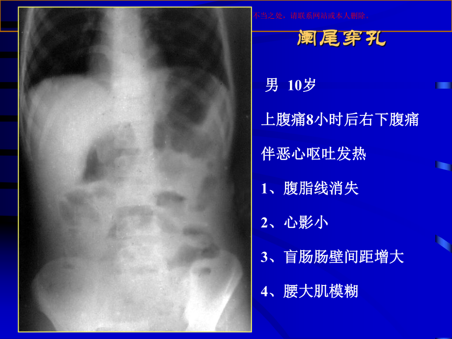 医学影像诊断急腹症影像诊断学培训课件.ppt_第3页