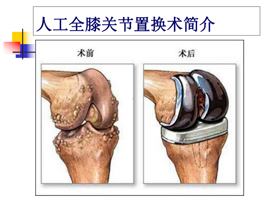 人工全膝关节置换术术前术后护理课件.ppt_第2页