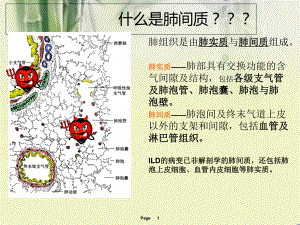 医学课件间质性肺炎专业医学知识宣讲.ppt