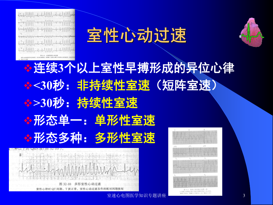 室速心电图医学知识专题讲座培训课件.ppt_第3页