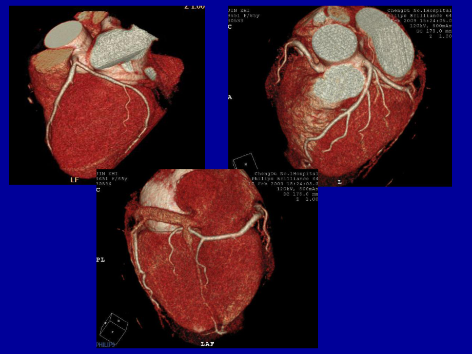 冠状动脉CTA成像-课件.ppt_第3页