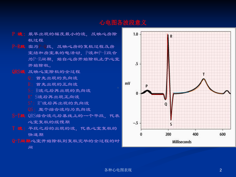 各种心电图表现培训课件.ppt_第2页