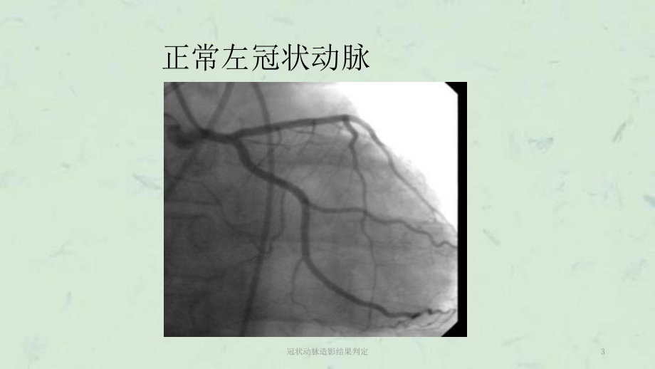 冠状动脉造影结果判定课件.ppt_第3页