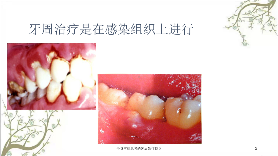 全身疾病患者的牙周治疗特点课件.ppt_第3页