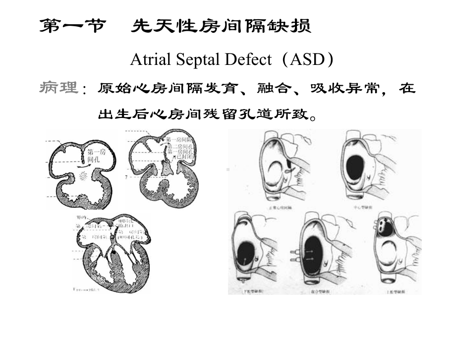 先天性心血管病课件-.pptx_第3页