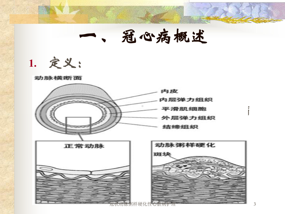 冠状动脉粥样硬化性心脏病护理培训课件.ppt_第3页