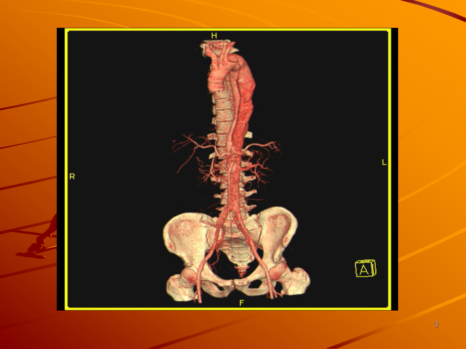 主动脉瘤概述学习课件.ppt_第3页