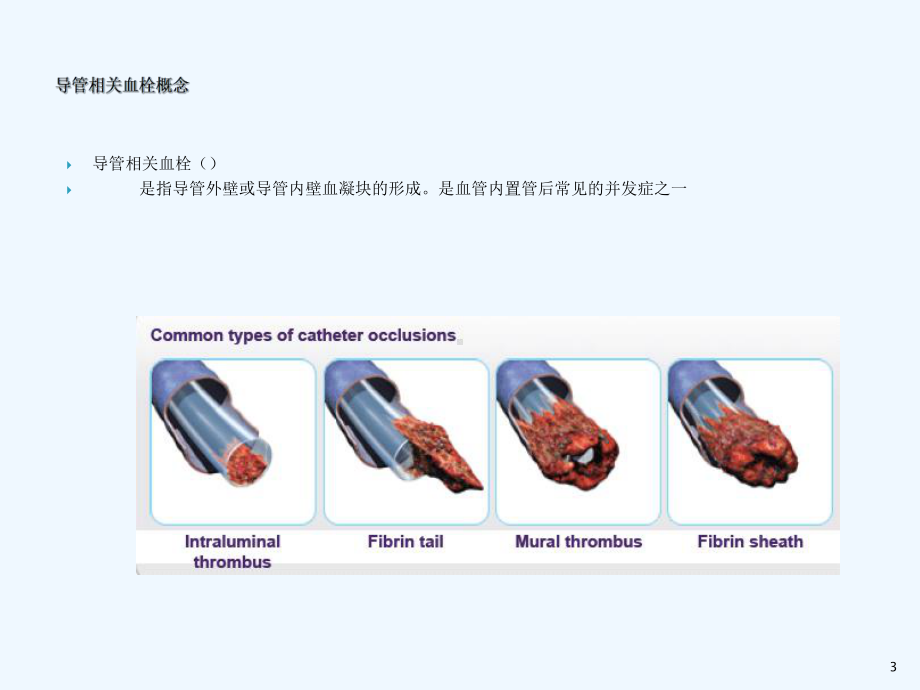 导管相关并发症血栓课件.ppt_第3页