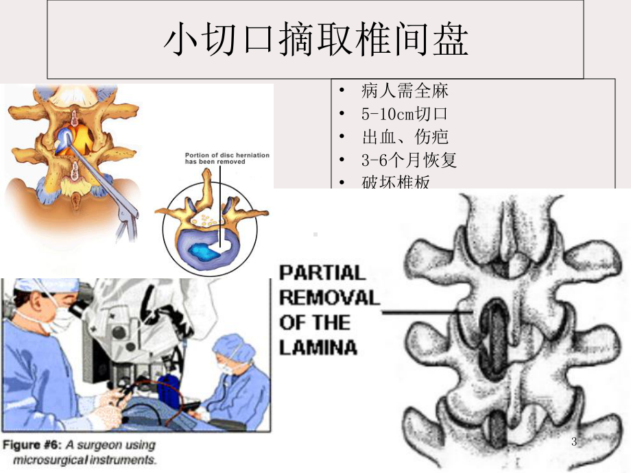 医学课件-不同脊柱微创技术简介课件.ppt_第3页