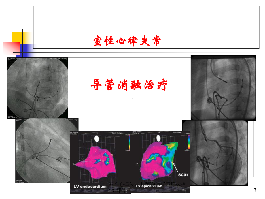 室性心律失常非药物治疗策略选择-课件.ppt_第3页