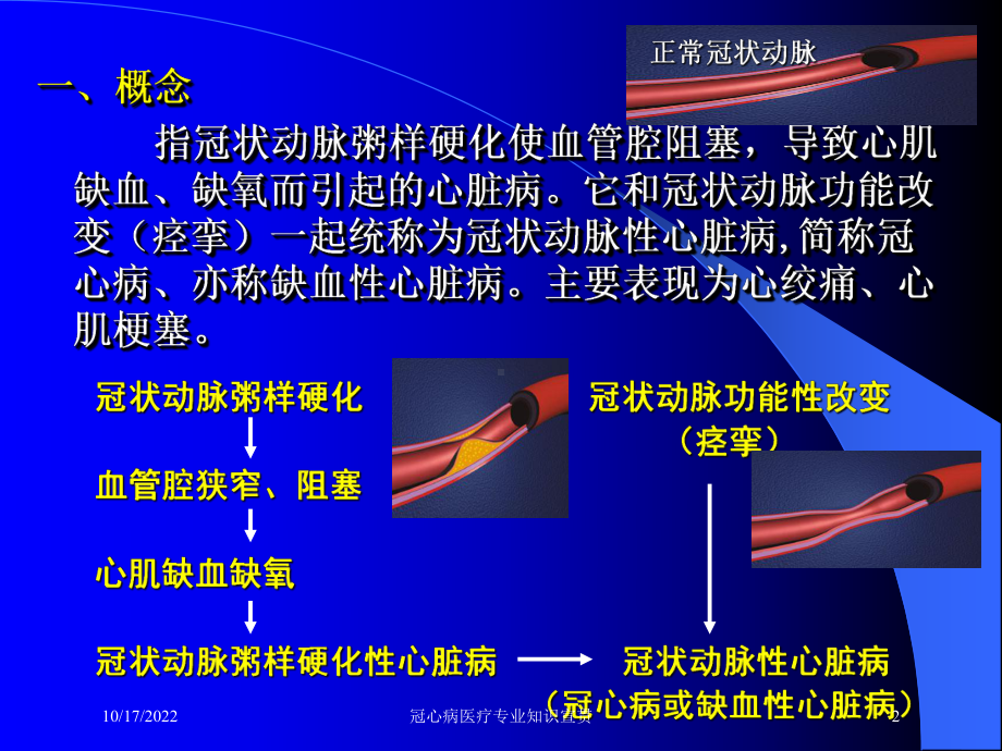 冠心病医疗专业知识宣贯课件.ppt_第2页