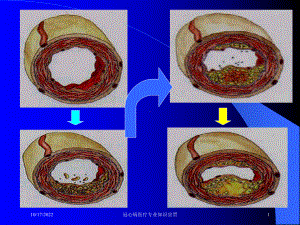 冠心病医疗专业知识宣贯课件.ppt