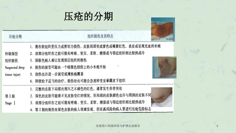 压疮伤口局部评估与护理记录指引课件.ppt_第3页