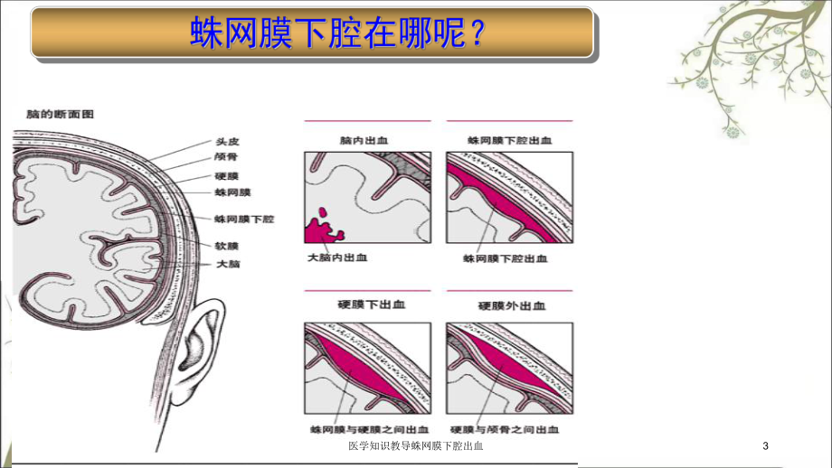 医学知识教导蛛网膜下腔出血课件.ppt_第3页