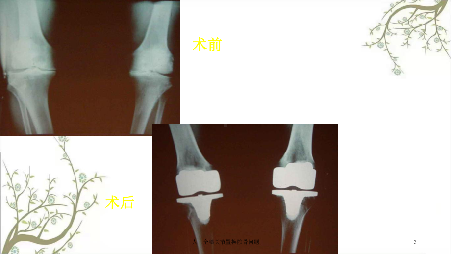 人工全膝关节置换髌骨问题课件.ppt_第3页