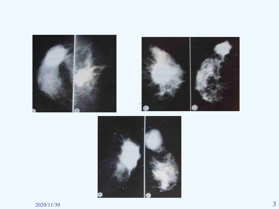 乳腺癌的线影像学表现课件.ppt_第3页