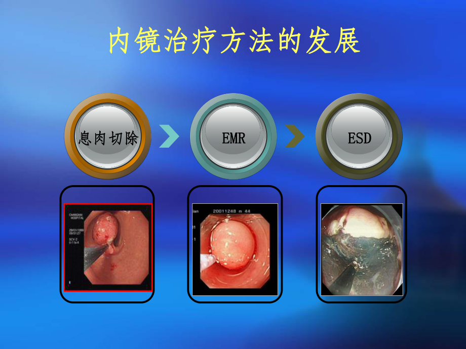 内镜下粘膜切除术课件-2.ppt_第2页