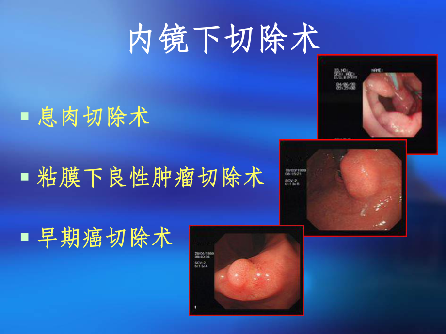 内镜下粘膜切除术课件-2.ppt_第3页