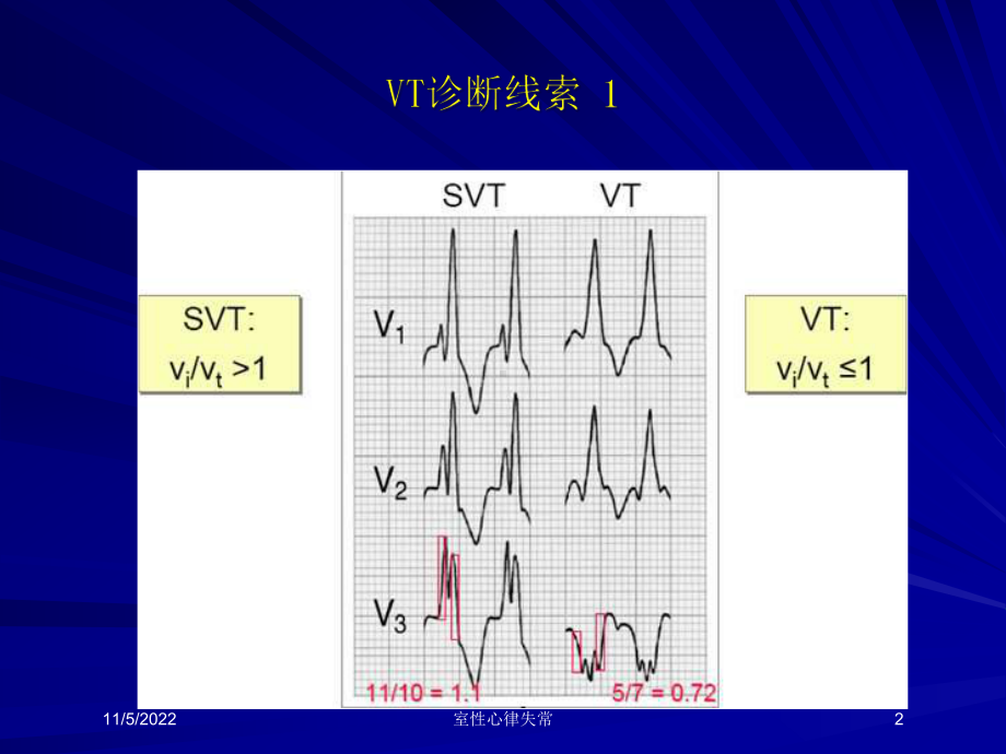 室性心律失常培训课件.ppt_第2页