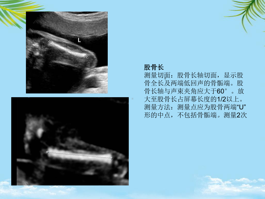 产科超声标准切面张图全面版课件.ppt_第3页