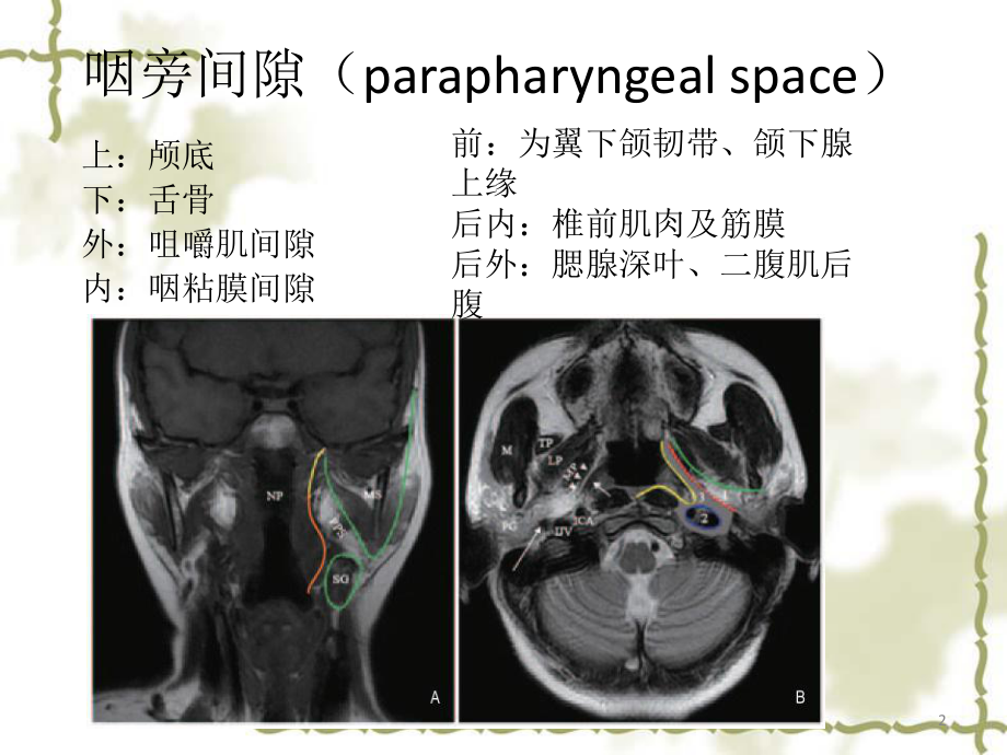 咽旁肿瘤的影像学诊断课件.pptx_第2页