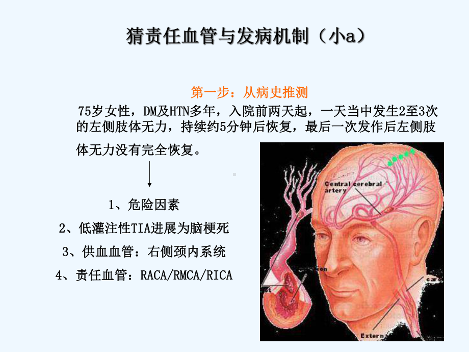 从影像学梗死部位推测责任供血血管课件.ppt_第2页