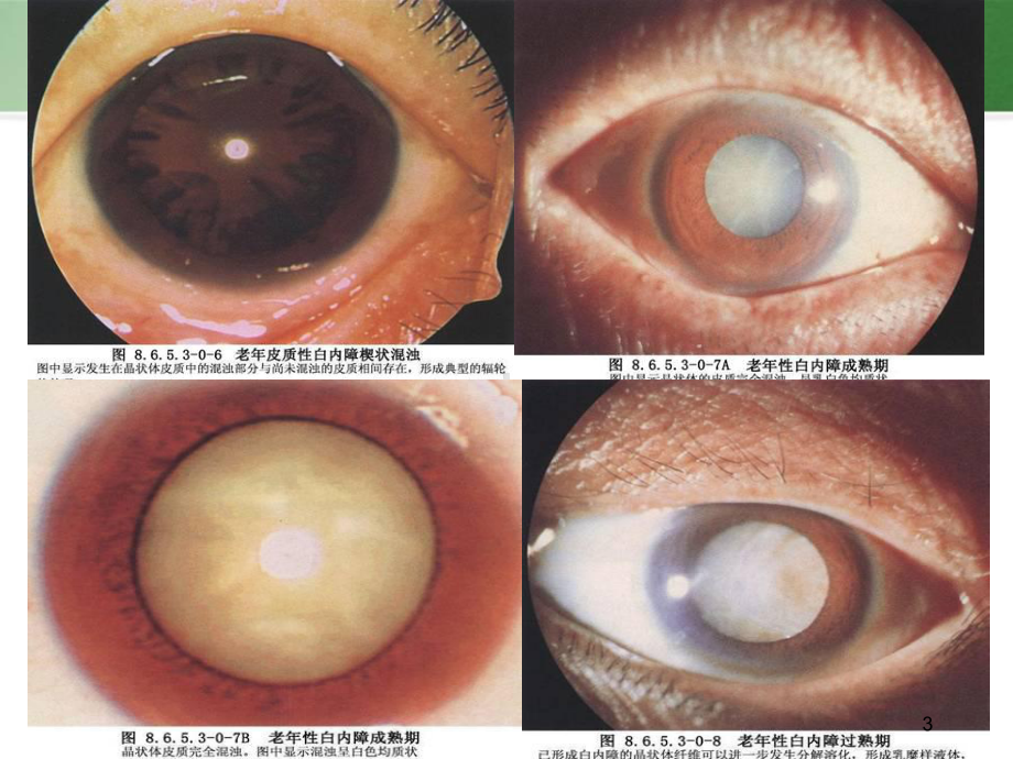 小切口白内障手术课件.pptx_第3页