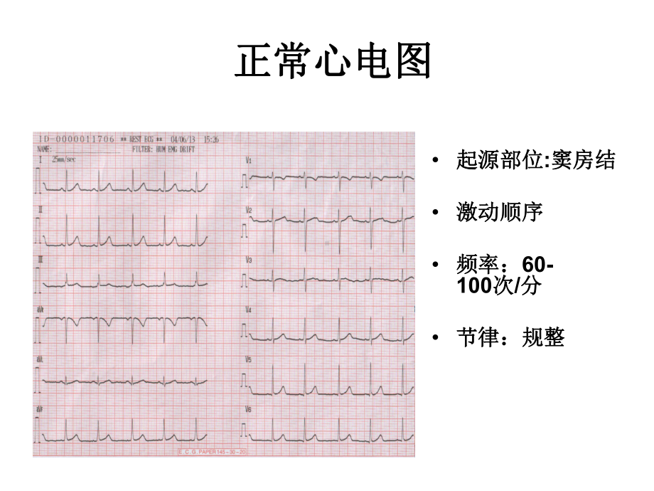 危急心律失常的识别及处理课件.ppt_第3页