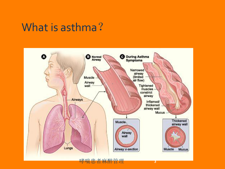 哮喘患者麻醉管理培训课件.ppt_第3页