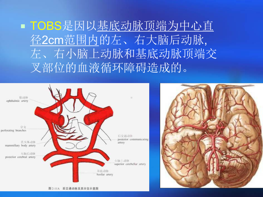 基底动脉尖综合征课件-2.ppt_第3页