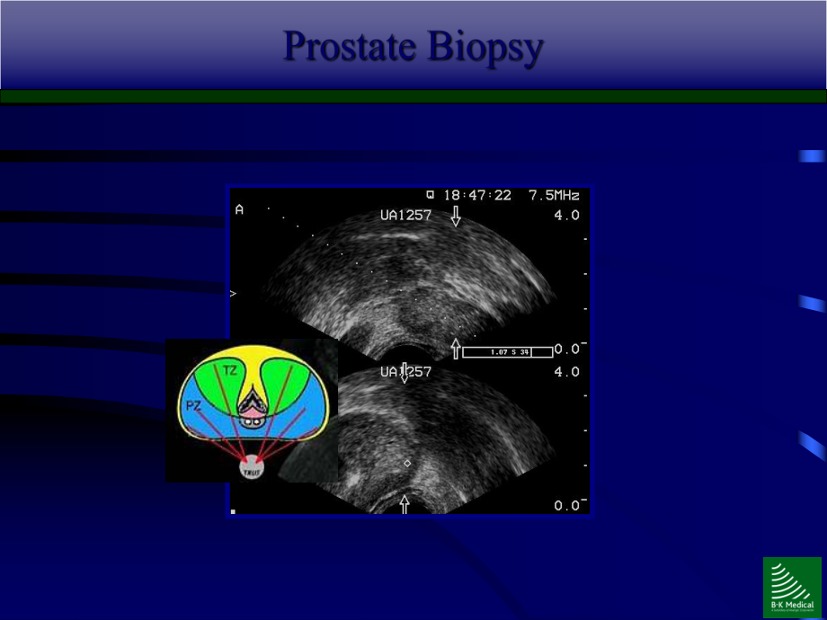 前列腺疾病的超声诊断培训课件.ppt_第2页