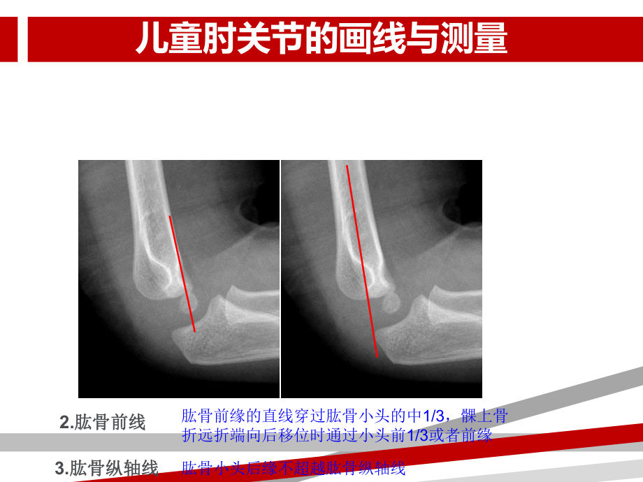 儿童肘关节损伤X线诊断课件.ppt_第3页