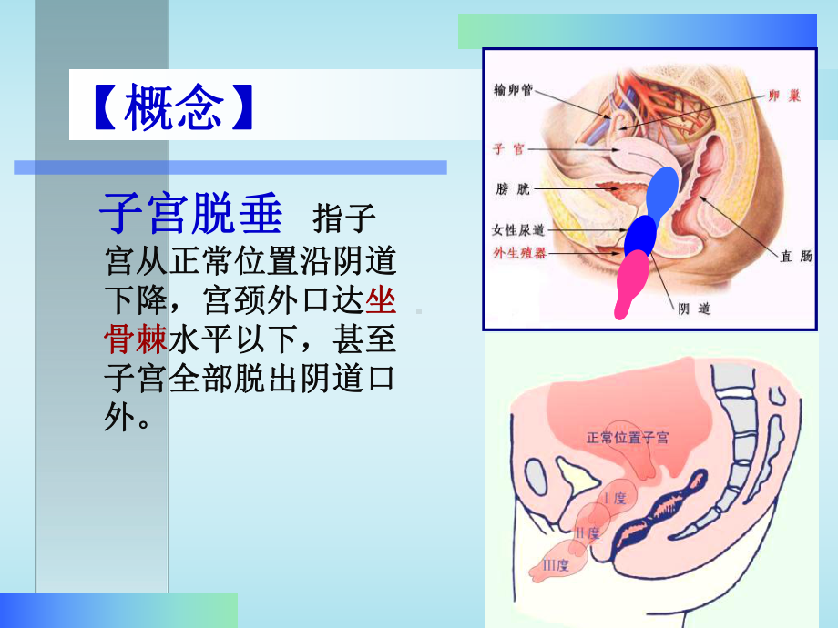 子宫脱垂课件-2.ppt_第2页