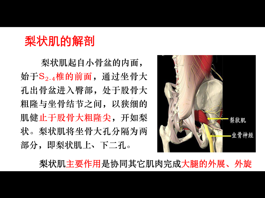 医学课件梨状肌综合征的影像诊疗.ppt_第2页