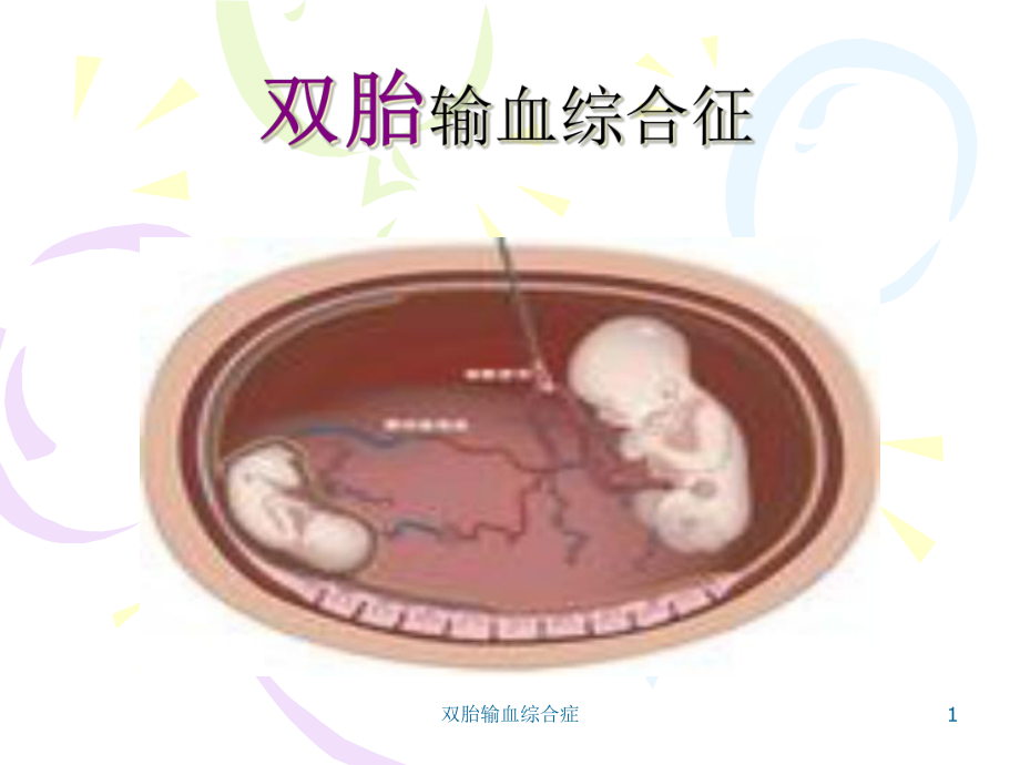 双胎输血综合症课件.ppt_第1页