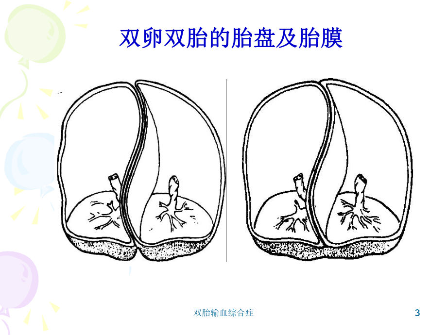 双胎输血综合症课件.ppt_第3页