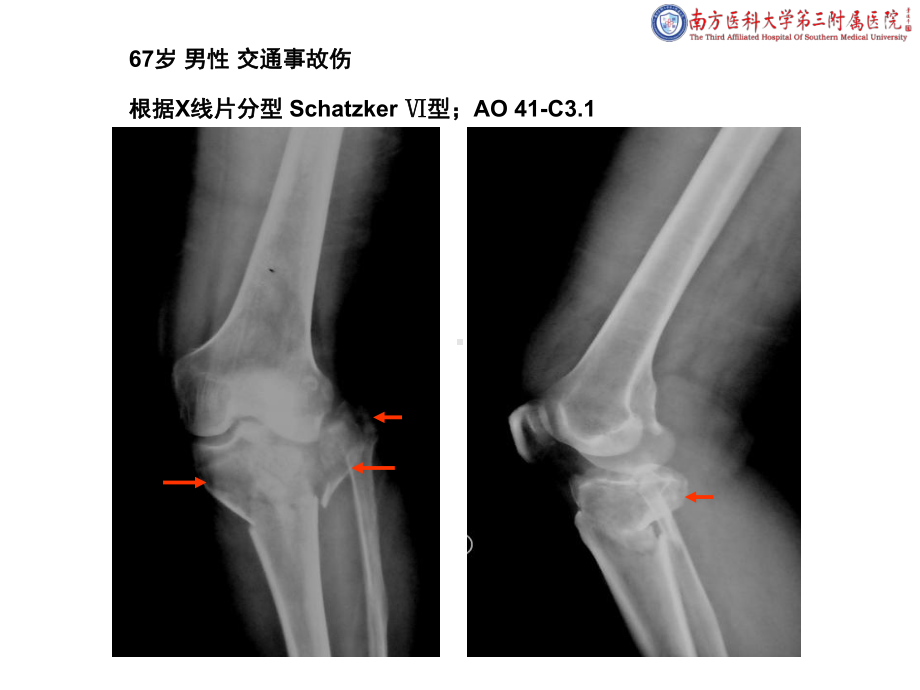 医学课件外侧扩大入路治疗胫骨平台骨折.ppt_第1页