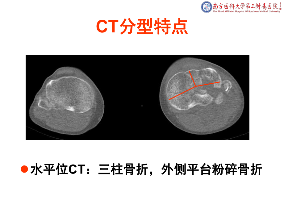 医学课件外侧扩大入路治疗胫骨平台骨折.ppt_第2页