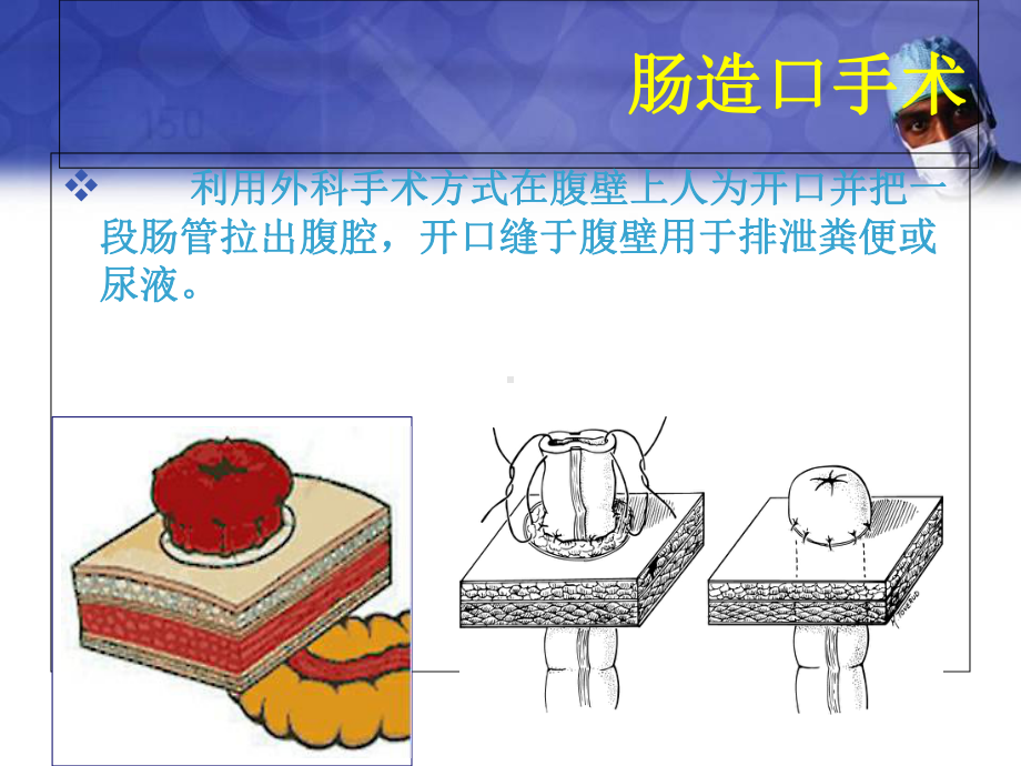 医学课件-造口术前定位课件.ppt_第3页