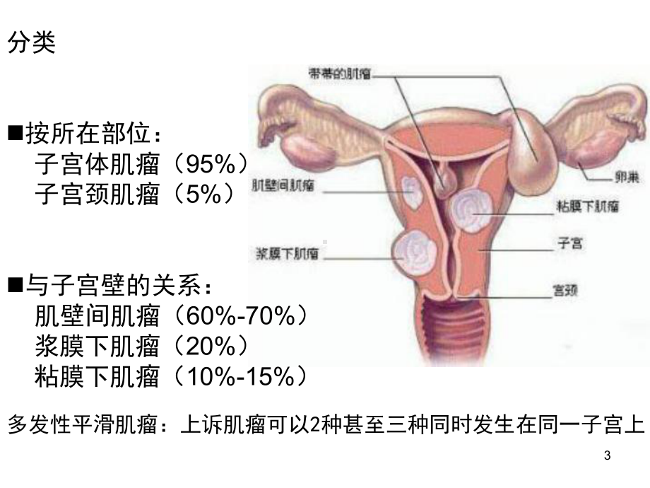 子宫平滑肌瘤课件.ppt_第3页