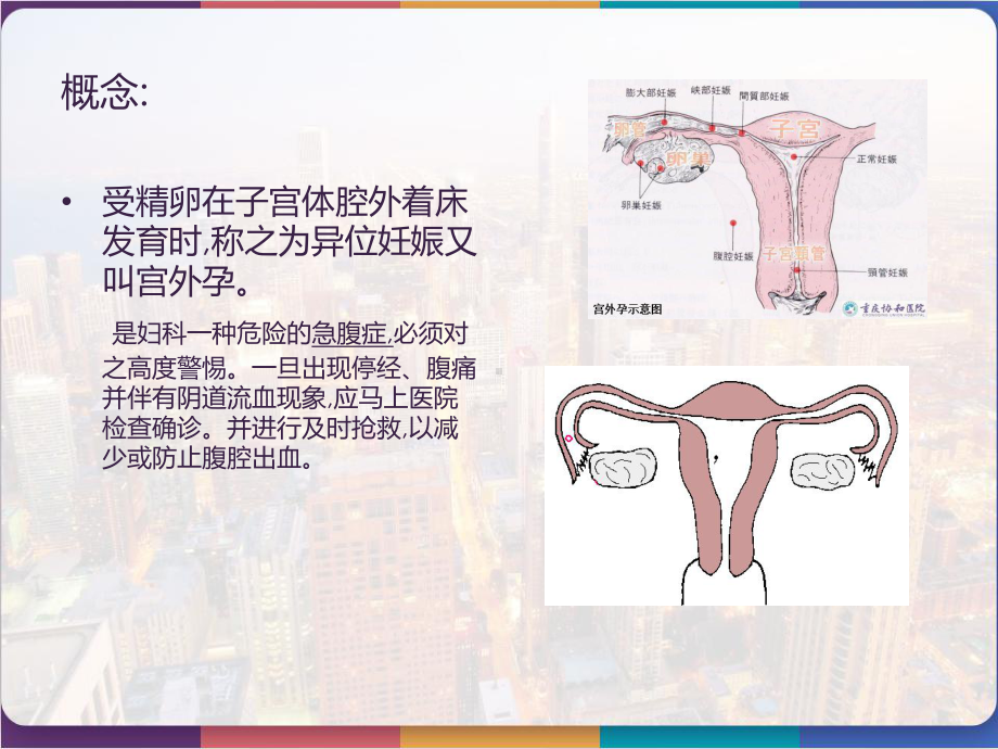 宫外孕腹腔镜术前术后的护理-课件.pptx_第2页