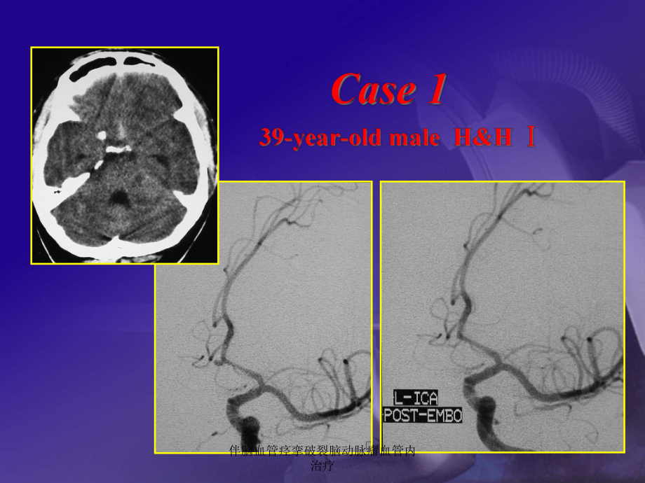 伴脑血管痉挛破裂脑动脉瘤血管内治疗课件.ppt_第3页