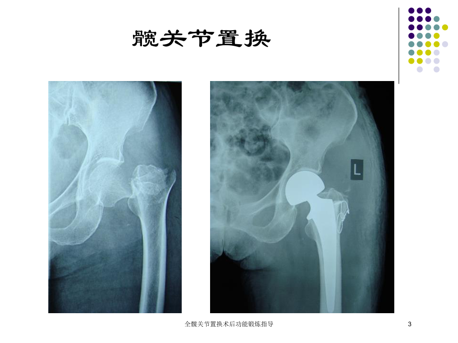 全髋关节置换术后功能锻炼指导培训课件.ppt_第3页