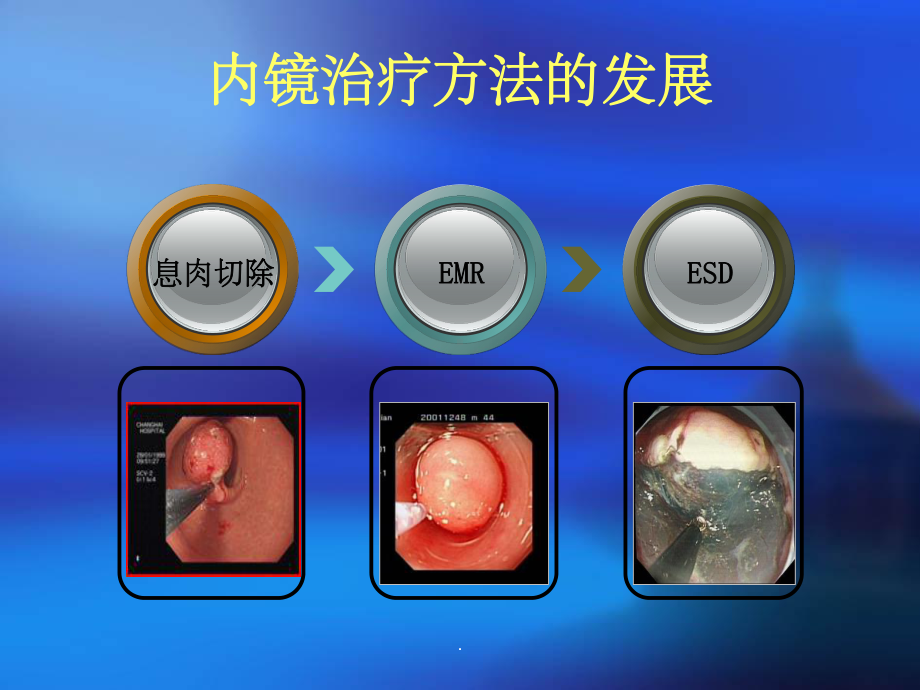 内镜下粘膜切除术课件.ppt_第2页