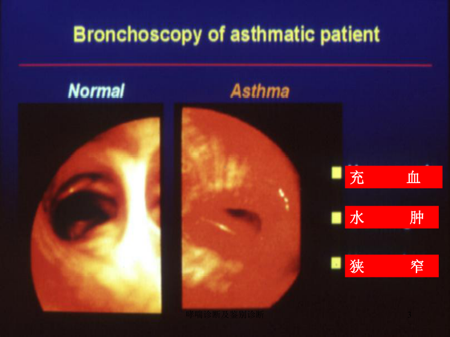 哮喘诊断及鉴别诊断培训课件.ppt_第3页