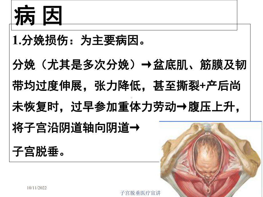 子宫脱垂医疗宣讲课件.ppt_第3页