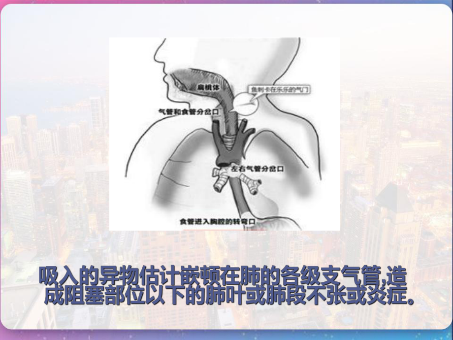 小儿气管异物取出术的麻醉处理-课件.pptx_第2页