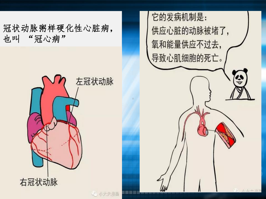 冠心病患者饮食健康教育课件.pptx_第3页